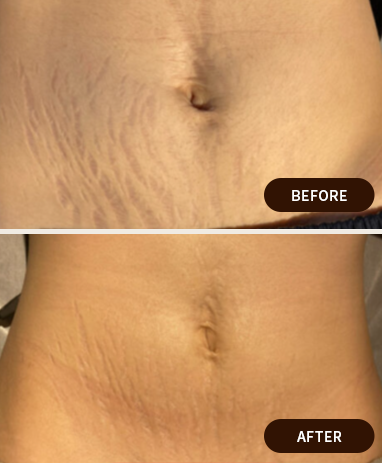 WINBACK 肉割れ・妊娠線ケア