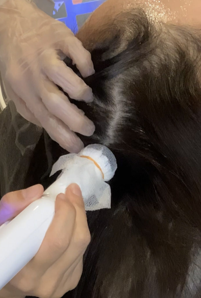 プラズマスカルプ